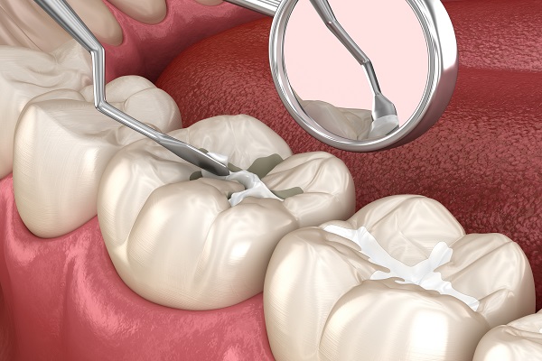 Dental sealants